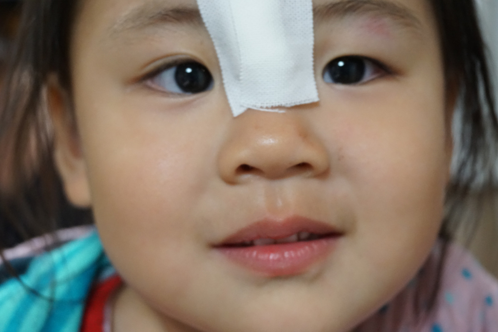 眉間を4針ほど縫いましたが なにか タクコナさん Acafe Aの写真投稿サイト ソニー